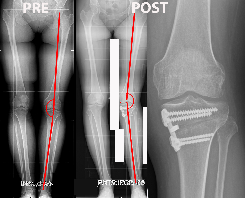 Osteotomia tibiale valgizzante con angolo dell'asse meccanico prima e dopo l'intervento