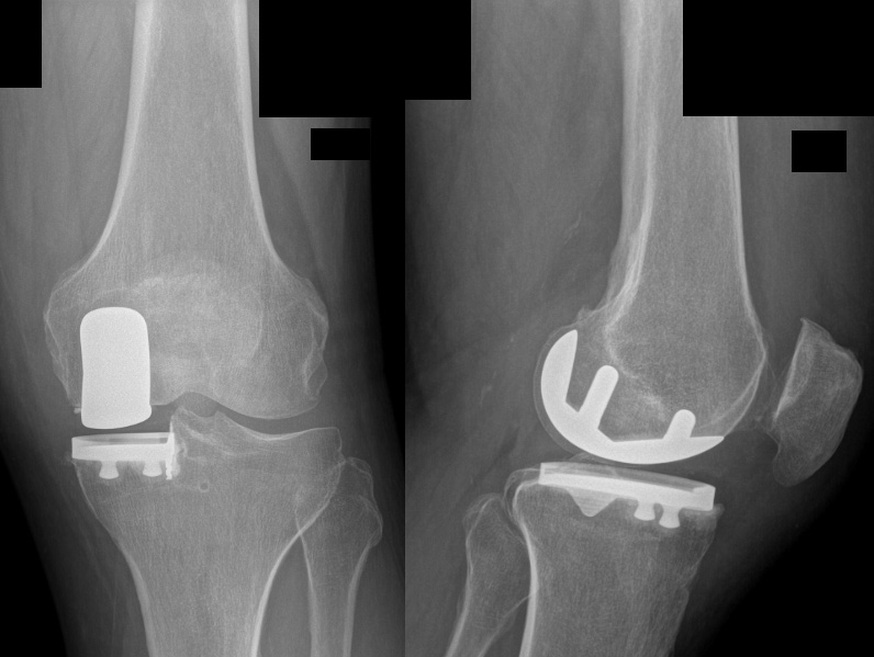 C:\fakepath\Radiografia dopo protesi monocompartimentale di ginocchio.jpg
