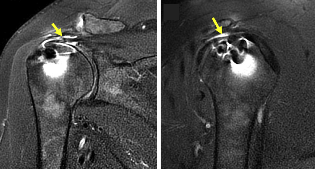 C:\fakepath\Recidiva lesione cuffia dei rotatori.jpg
