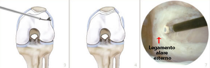 Schema intervento di sezione legamento alare esterno in artroscopia ginocchio
