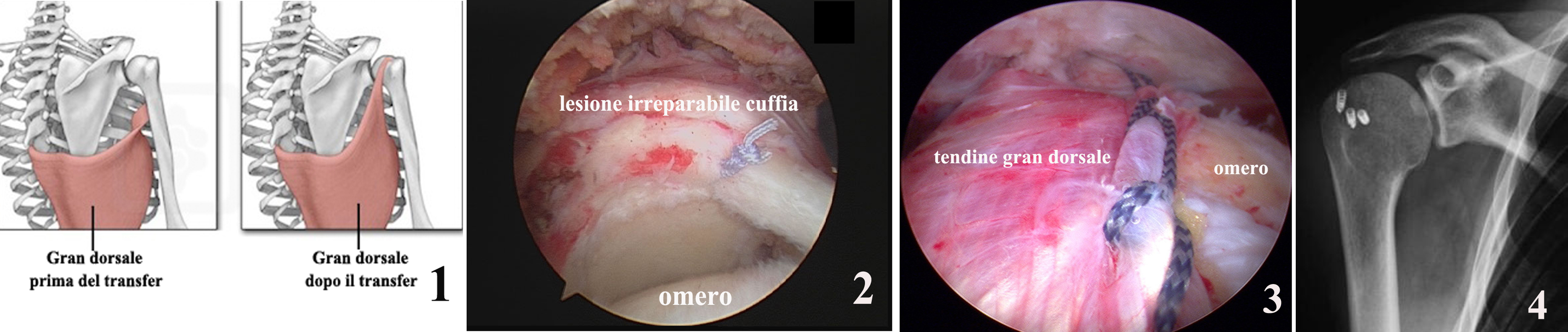 C:\fakepath\Schema intervento di trasferimento (o transfer) gran dorsale in artroscopia.jpg