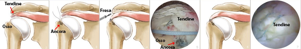 Schema intervento riparazione tendini cuffia dei rotatori