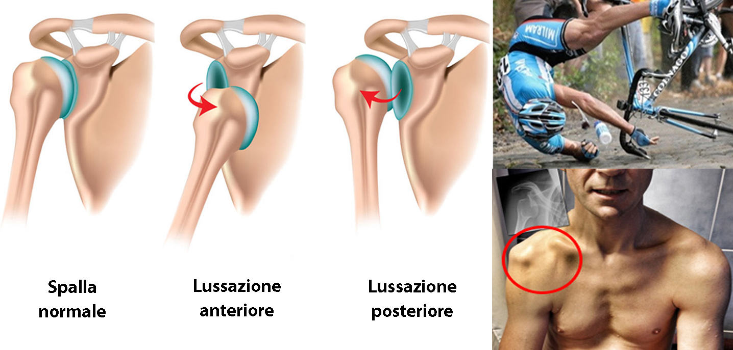 Schema lussazione spalla