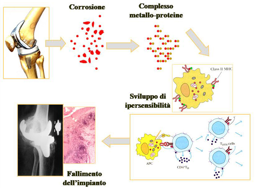 C:\fakepath\Schema sviluppo reazione allergica al materiale di una protesi.jpg