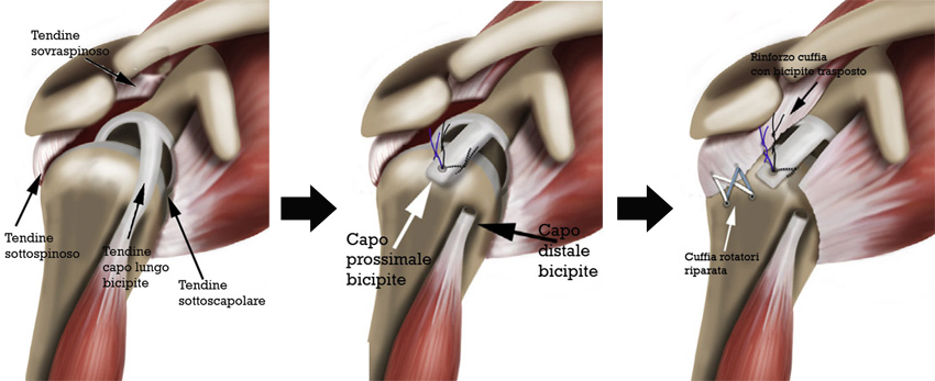 Tecnica moderna di ricostruzione capsulare con tendine bicipite alla spalla