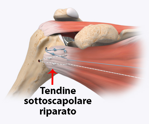 Tendine sottoscapolare riparato