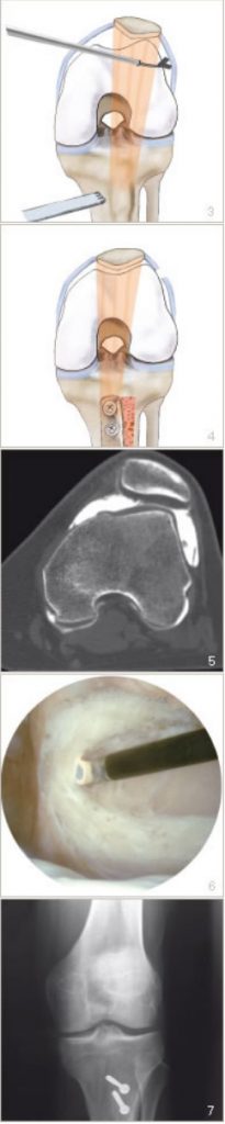 Schema intervento di trasposizione tuberosità anteriore di ginocchio