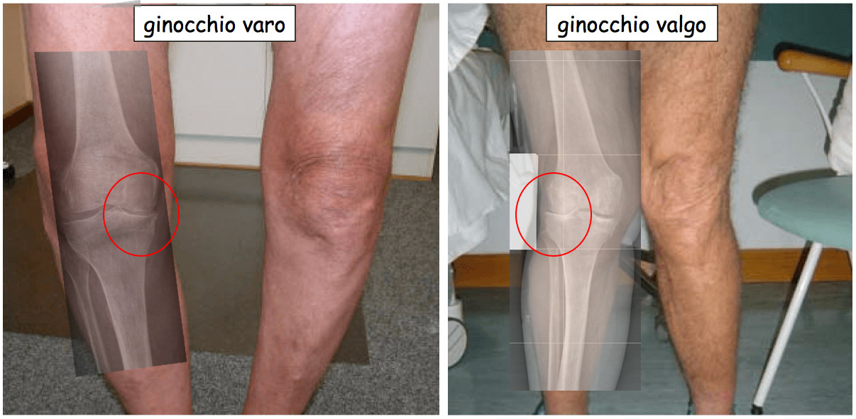 Un ginocchio varo o valgo ha un'usura maggiore nel compartimento più soggetto al carico