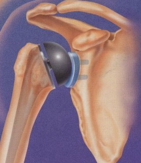 Schema intervento protesi di spalla