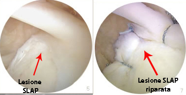 Lesione SLAP riparata