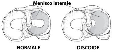 menisco discoide