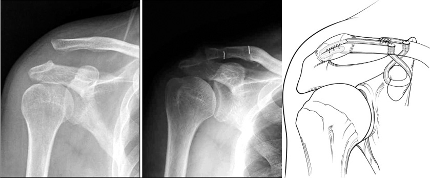 Ricostruzione con tendine di lussazione cronica acromion claveare. Radiografia prima e dopo l’intervento, schema intervento