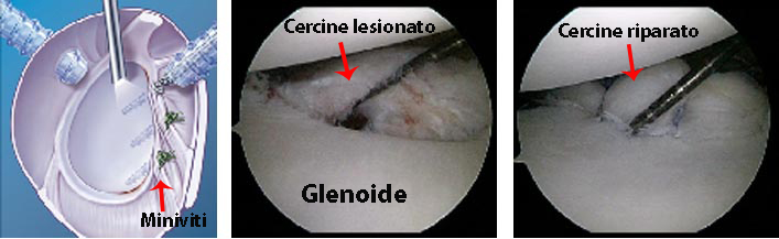 schema intervento capsuloplastica o riparazione cercine della spalla